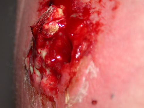 images_my_ideas_21/21_WC_Jbtank_Mrsa_cyst_exploded.jpg